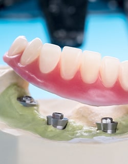 Example of implant dentures at Robert C. Sikes, DDS